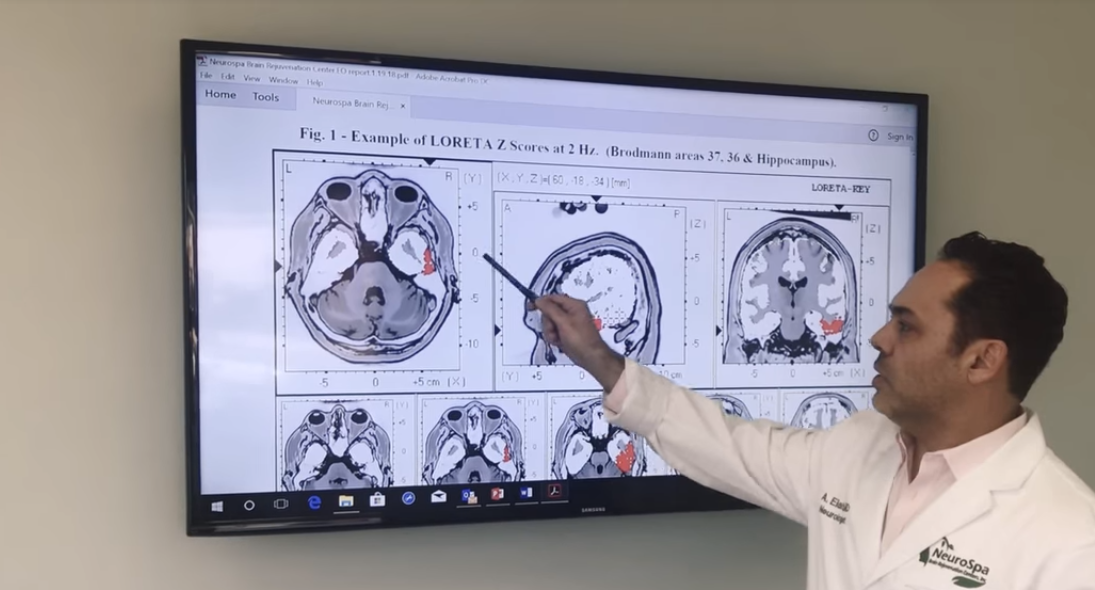 Concussion on Brain Map
