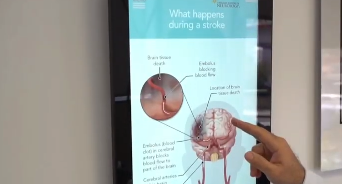 TMS for Stroke Recovery