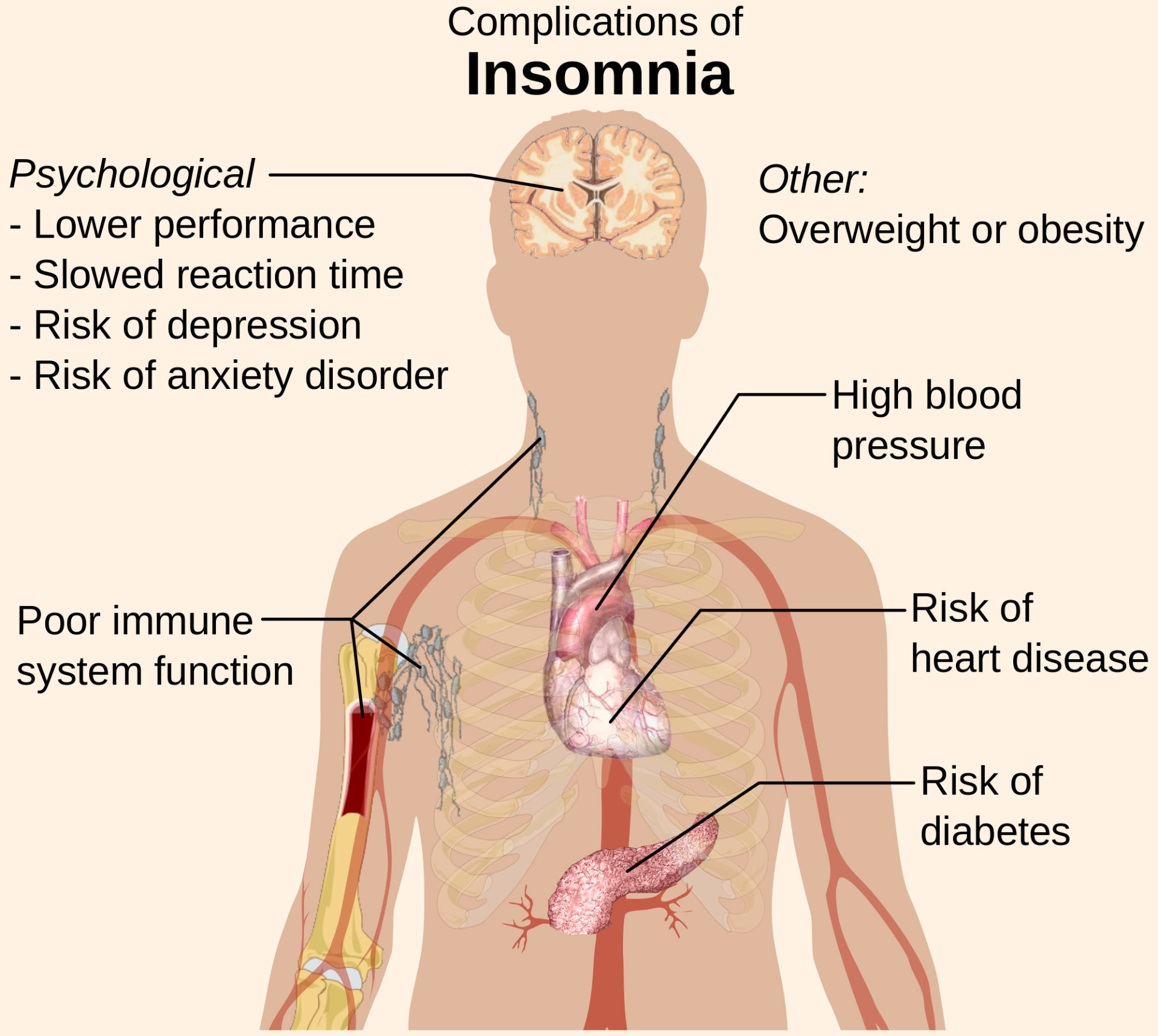 What Stage Of Sleep Does Insomnia Occur