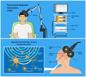 TMS Clinic | Transcranial Magnetic Stimulation Therapy