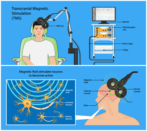 Transcranial Magnetic Stimulation Therapy