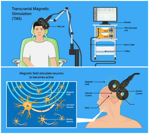 TMS Clinic Transcranial Stimulation Therapy