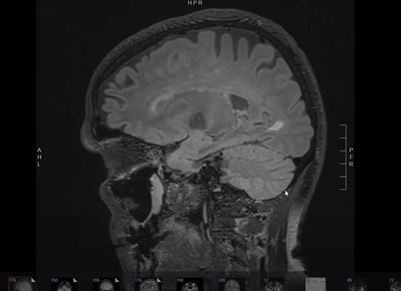MRI of Severe Headache