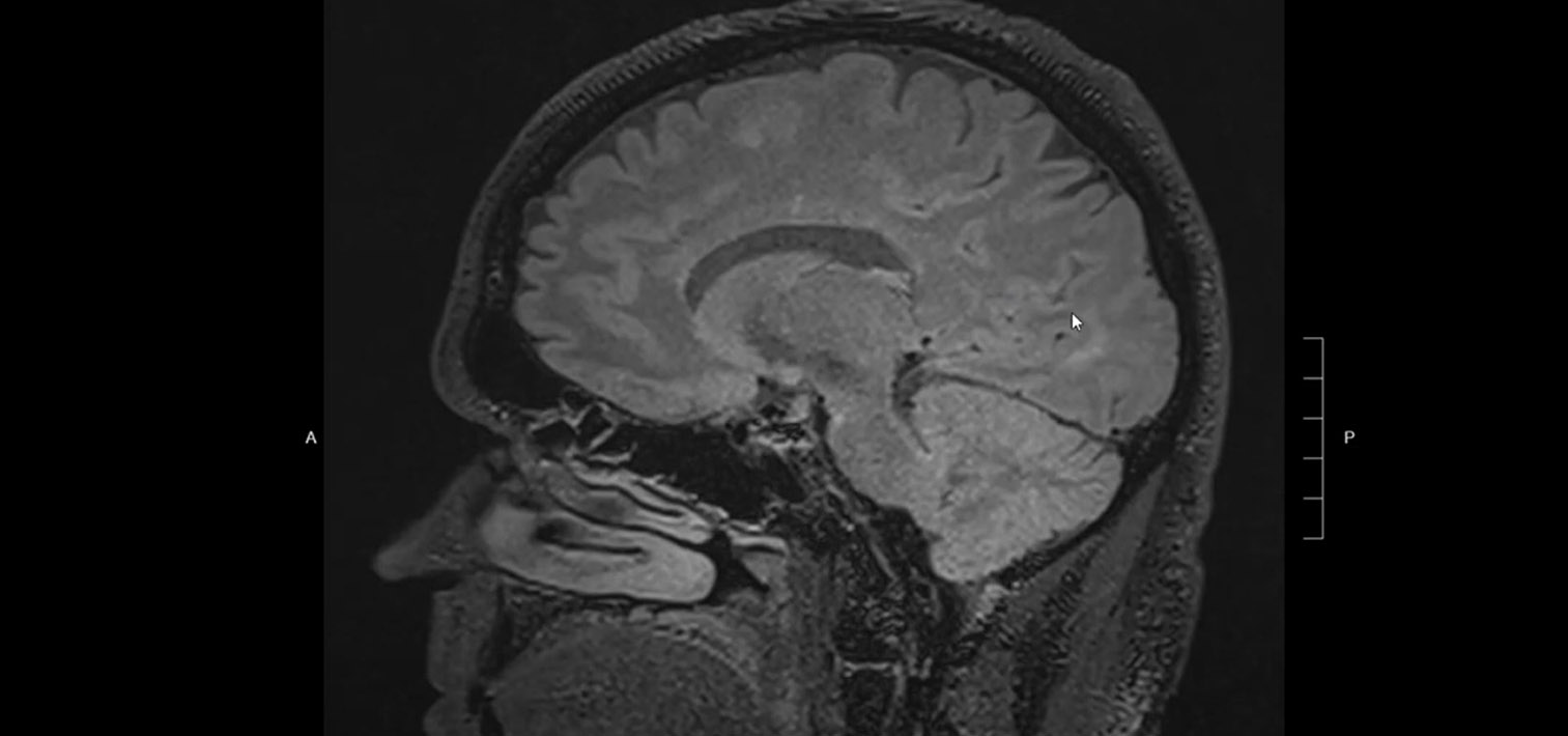 What does MS (Multiple Sclerosis) look like on brain MRI? Avoid wrongful diagnosis!